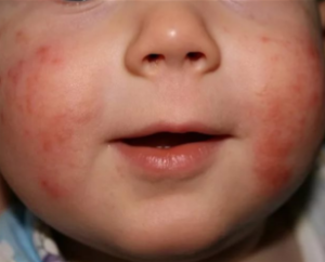Акне новорожденных или аллергия